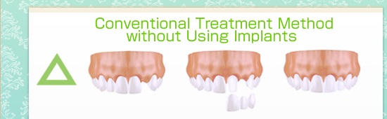 インプラントを用いない従来の治療法