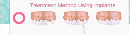 横須賀ワンラブデンタルのインプラントを用いた治療法