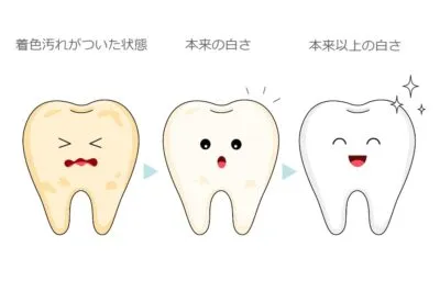 Illustration comparing stained teeth, natural whiteness, and whiter-than-natural teeth